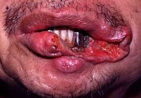 How To Quit Chewing Tobacco Painlessly